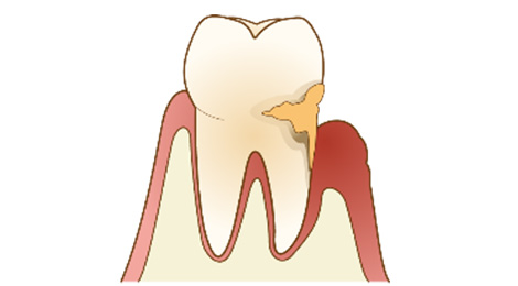 歯周病