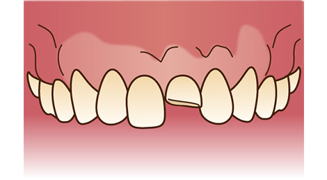 歯が欠けた