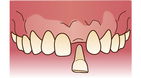 抜歯したままの状態