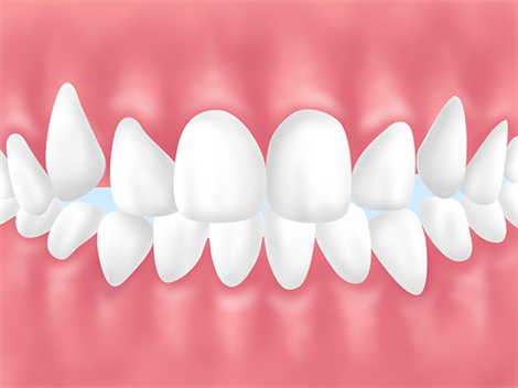 悪い歯並びが原因で起こりうること