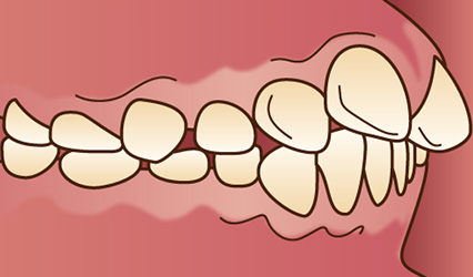 上顎前突