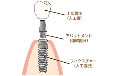 インプラントの構造と種類